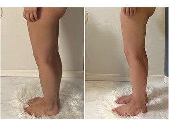 モア(moa)/痩身/下半身痩せ/むくみケア