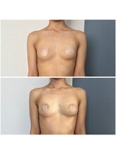 モア(moa)/産後ママもバストUP!