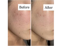 サロン ウーカ(salon WOOCA)/REVI【ニキビ/赤み】