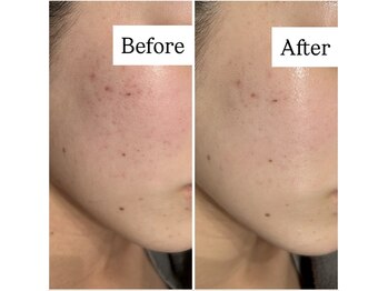 サロン ウーカ(salon WOOCA)/REVI【ニキビ/赤み】