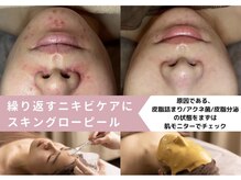 コキュウ(KOKYU)/肌質改善 スキングローピール