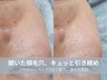 【速攻トーンアップ】プラズマ×ハーブピーリングでニキビ毛穴ケア