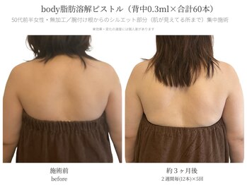 サボラミ(sabor A Mi)/背中のハミ肉に脂肪分解ピストル