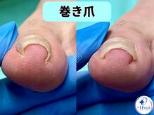 プラスワンフット 本厚木(+1 Foot)/筋トレで踏ん張ると痛む巻き爪