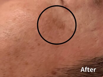 ダイヤモンド リーエンダ(Diamond leende)/クレイハーブピーリング