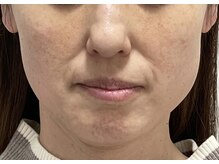 サロン ド アンジェリーナ(Salon de Angelina)/40代　お悩み改善 (1年後)