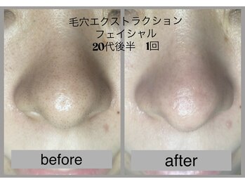 ブリノス(BLINOSS)/毛穴エクストラクション