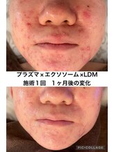 リラ(Lilas) エクソ ソーム