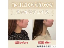 顔凛(カオリン)/20代女性の小顔矯正