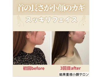 顔凛(カオリン)/20代女性の小顔矯正