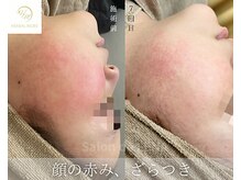 サロンドレナ 名駅店/ハーブピーリング サロンドレナ