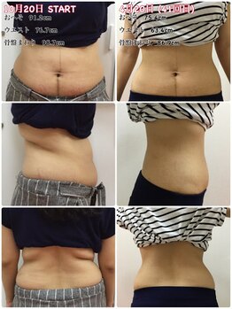 らくなん接骨院 鍼灸院/ぽっこりお腹にお悩みの方