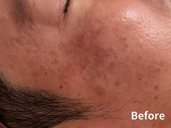 ダイヤモンド リーエンダ(Diamond leende)/クレイハーブピーリング