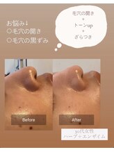 天使の艶肌/ハーブピーリング before/after2