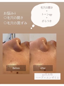 天使の艶肌/ハーブピーリング before/after2