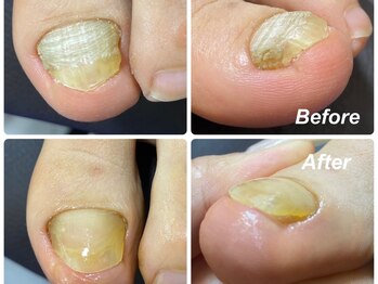 爪のいろは/自分じゃ切れない…肥厚爪のケア