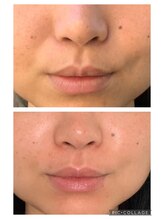 ラパス(Lapaz)/毛穴レスを目指す