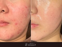 【季節の変わり目のゆらぎ】ホームケア方法もしっかりアドバイス