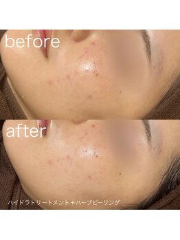 ルルラ リコ(lulula rico)/症例写真/ハーブピーリング