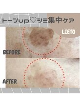 リエート(LIETO)/【シミ集中ケアbefor×after】