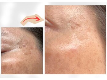 香嬉琉/シミお悩みに★エイジングケア