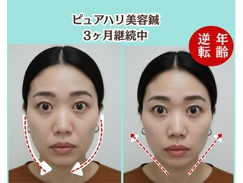 ピュアハリ/沖縄美容鍼 効果