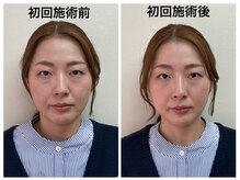 トータルバランス整体院 &nbsp;オレンジ(ORANGE)/小顔矯正+顎関節矯正　モニター