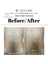 アイラッシュサロン ドール(Doll)/【メンズ】腹脱毛
