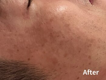 ダイヤモンド リーエンダ(Diamond leende)/クレイハーブピーリング