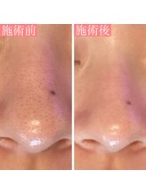 エクラ アン(eclat.un)/20代女性：毛穴洗浄