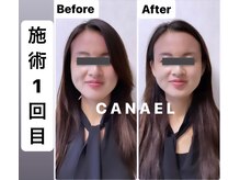 カナエル(CANAEL)の雰囲気（施術変化）