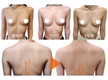 エミュボディ 青山本店(emu body)/バストアップ写真　乳房リリース