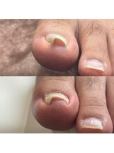 リリ(lili)/巻き爪矯正/5回目