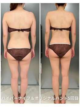 リッシュボーテ(RICHE BEAUTE)/【広尾/ハイパーナイフ/痩身】