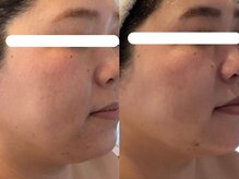 ジョーヌ(JAUNE)/毛穴・肌荒れ跡の黒ずみも改善