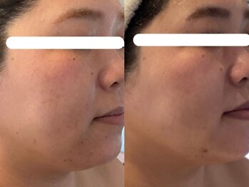 ジョーヌ(JAUNE)/毛穴・肌荒れ跡の黒ずみも改善