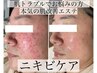 本気のニキビケア！ 肌質改善エステ