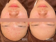 ウォーム(warm)/ニキビケア/肌荒れ/ニキビ肌