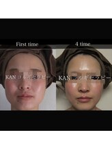 美骨(BIKOTSU)/美骨小顔矯正コルギ