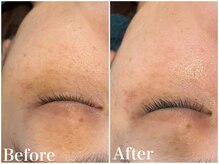 サロンドフェイス(Salon de Faith)/ハーブピーリング