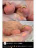 【まずはカウンセリングから】フットネイルケア☆巻き爪にお悩みの方