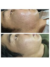 ベル(BELL)/肌荒れにお悩み