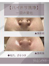 リグレア 浦安(Re.GLARE)/毛穴、くすみ