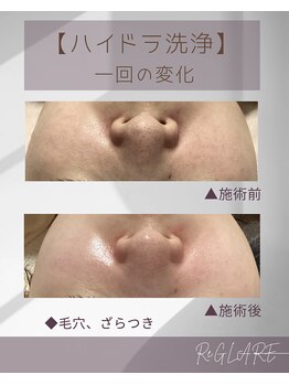 リグレア 浦安(Re.GLARE)/毛穴、くすみ