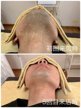 ティアレ 緑井店(Tiare)の写真/メンズ脱毛は当たり前の時代!ヒゲ脱毛で毎朝の面倒な髭剃りから解放!ワキ脱毛で汗のニオイ予防にも♪