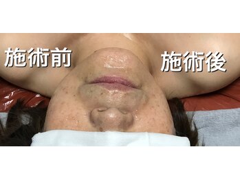 リラクゼーションサロン カネサチ/美肌光フェイシャル