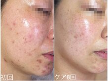 ラブリボン/ケア8回・5か月の変化