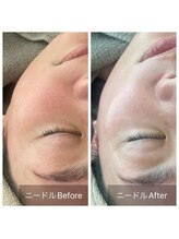 アークポノ(ark pono)/NPVA1ピーリング