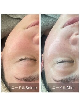 アークポノ(ark pono)/NPVA1ピーリング