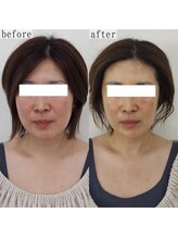 ヴェルシック(Belchic)/オプションで美白と保湿も叶う